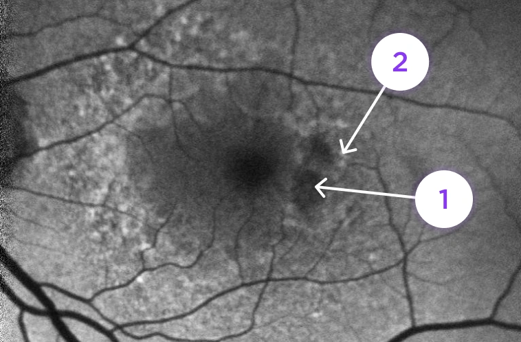 Fundus Autofluorescence