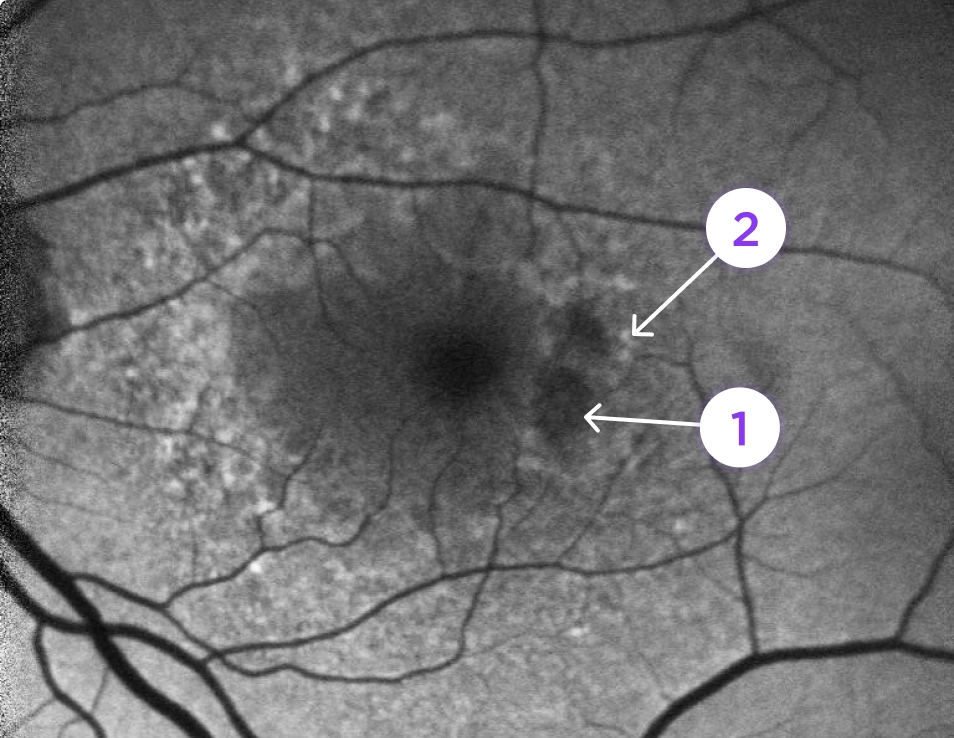 Fundus Autofluorescence