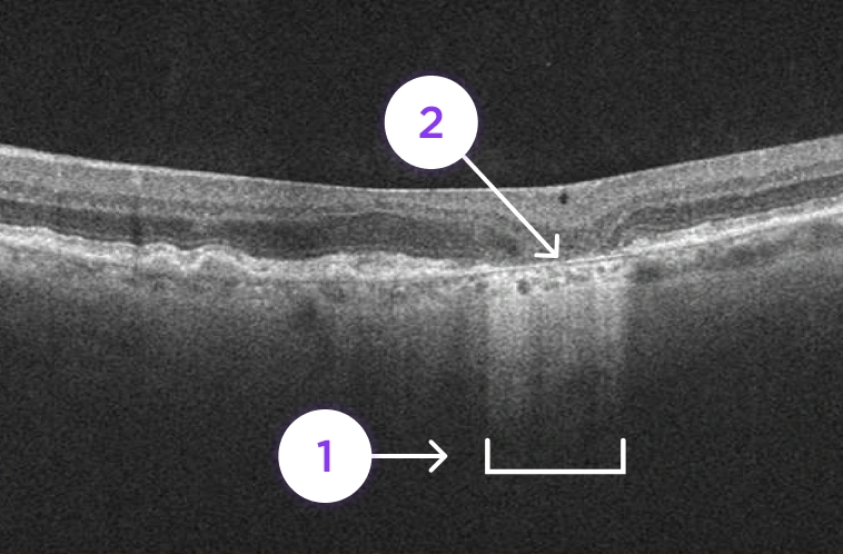 Optical Coherence Tomography